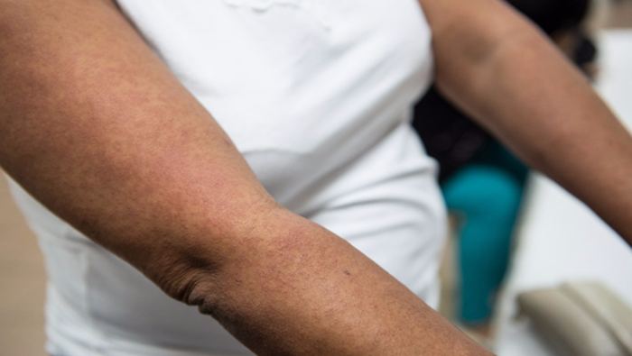 Uno de los síntomas de virus Zika es el brote de sarpullido en la piel.